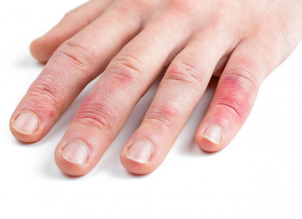 The hands are a common location for perivascular dermatitis.