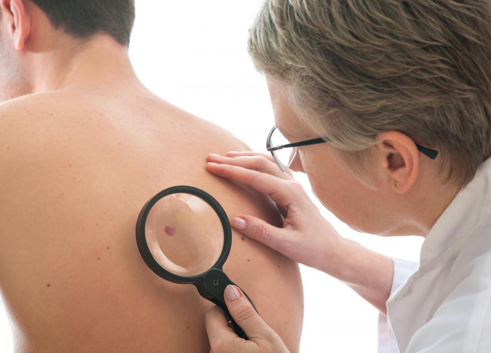 Dermatologists typically recommend that even small moles be diagnosed for skin cancer or other potential problems.