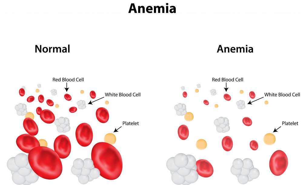 Angiodysplasia may cause anemia due to gastrointestinal bleeding.