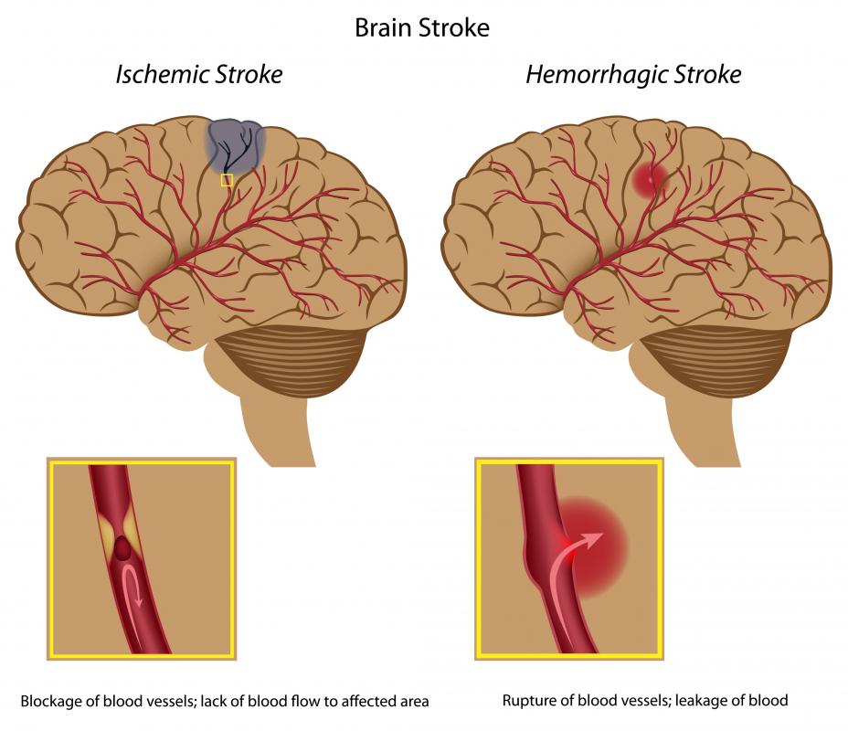 A diagram of an ischemic stroke and a hemorrhagic stroke, both types of massive strokes.