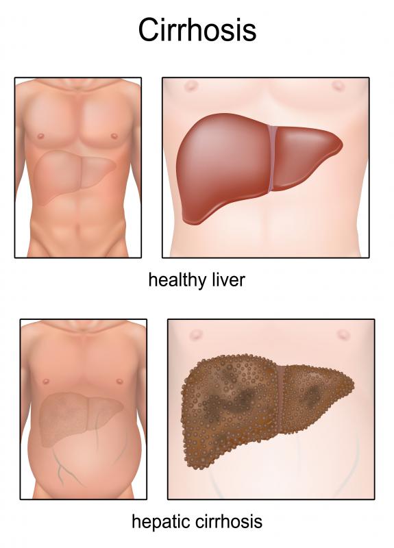 Milk thistle cannot reverse the effects of cirrhosis.