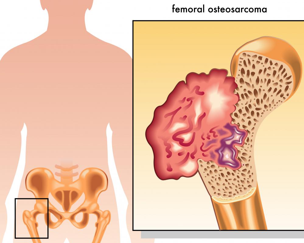 Osteosarcoma is malignant tumors that grows inside bones.