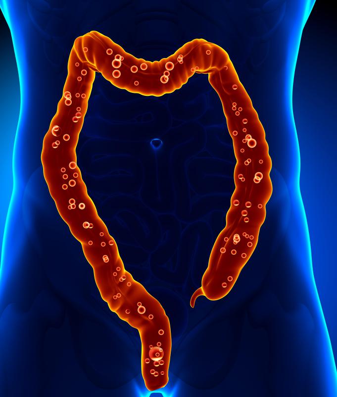 Clindamycin has been shown to cause an infection of the large intestine known as pseudomembraneous colitis.