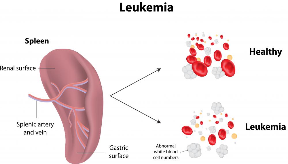 Leukemia leads to a significant increase in immature or abnormal blood cells in the body, causing the spleen to become enlarged.