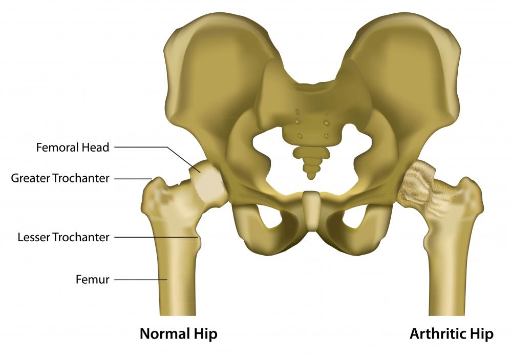 Arthritis in the hip may be the cause of sharp pain.