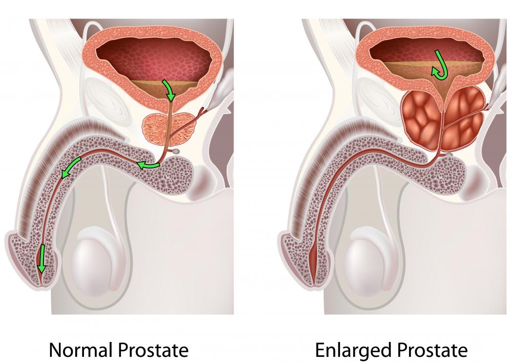 An enlarged prostate may cause an atonic bladder.