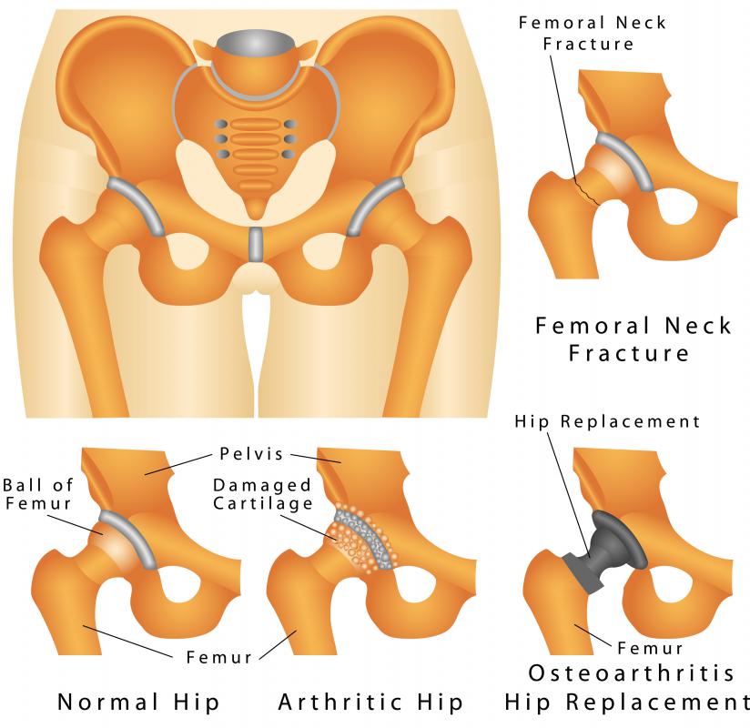 Arthritis and injury to the hip may cause bilateral hip pain.