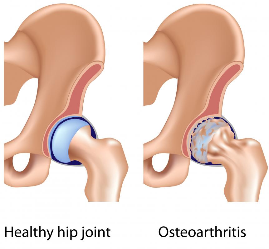 A healthy hip and one with osteoarthritis.