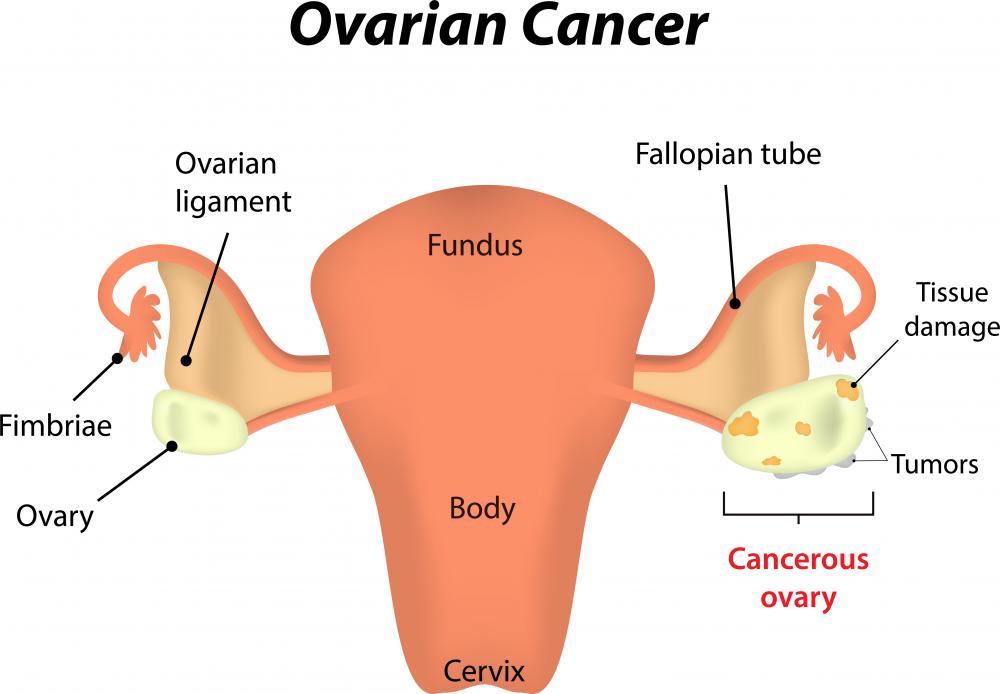 Certain types of ovarian cancer may require a salpingectomy.