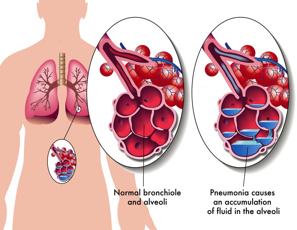 Bacterial pneumonia causes the alveoli, the tiny air sacs in the lungs, to become inflamed and filled with fluid.