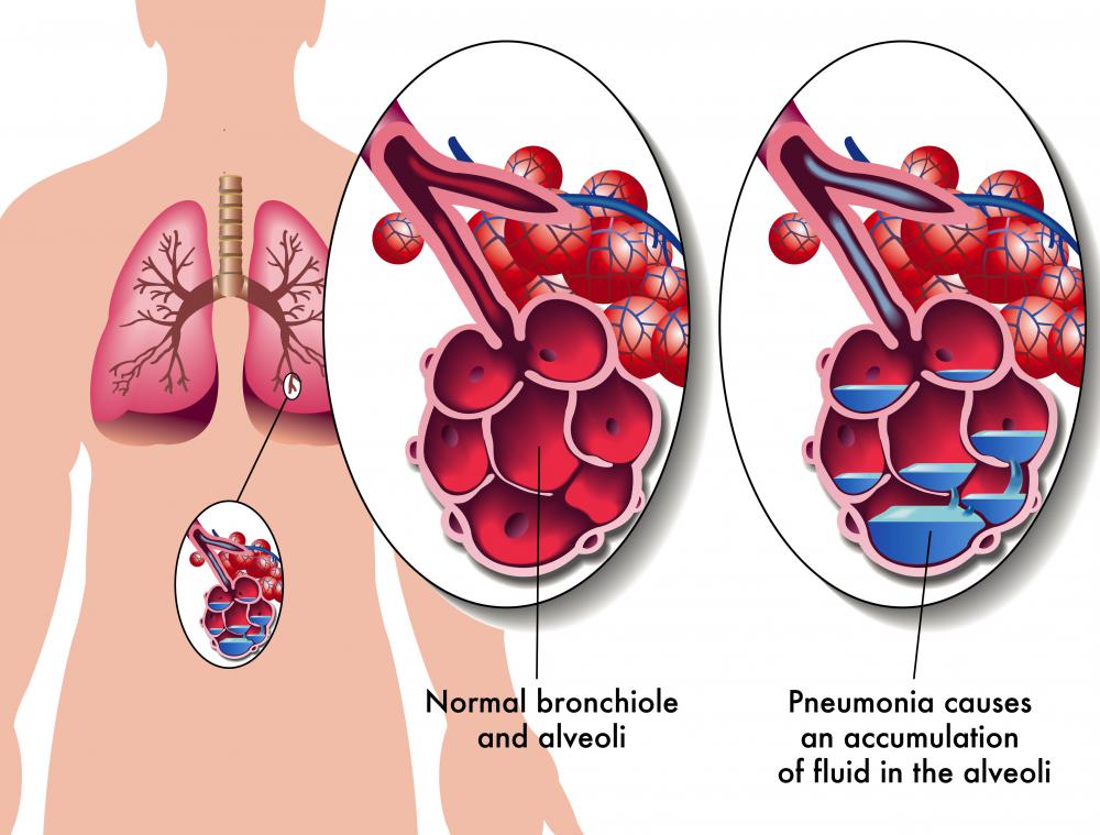 Pneumonia may cause nephritis.