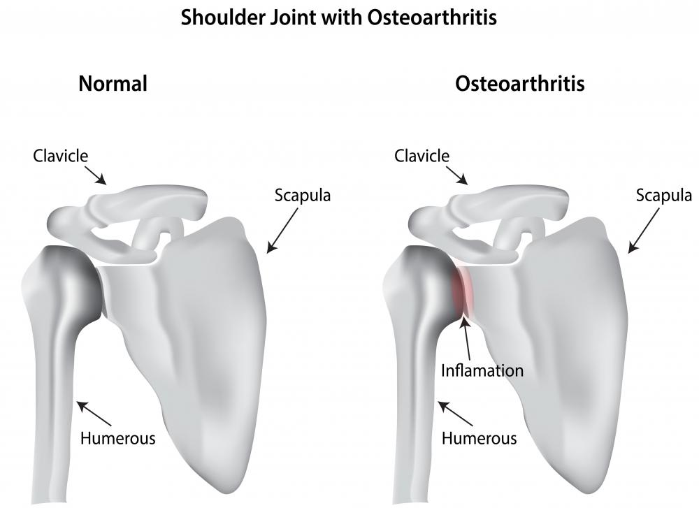 Leukocytosis may occur as a result of osteoarthritis.