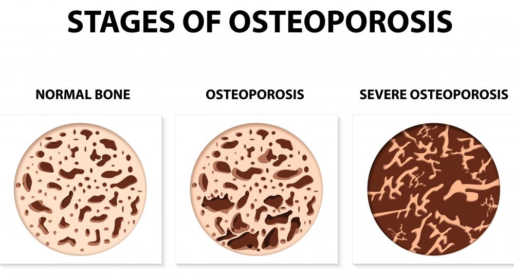 Genistein appears to have effects against the bone loss that occur with osteoporosis.