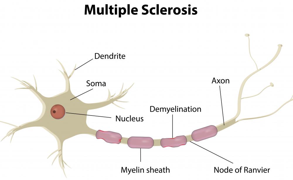 Experiments have suggested that threonine may help manage the symptoms of multiple sclerosis.