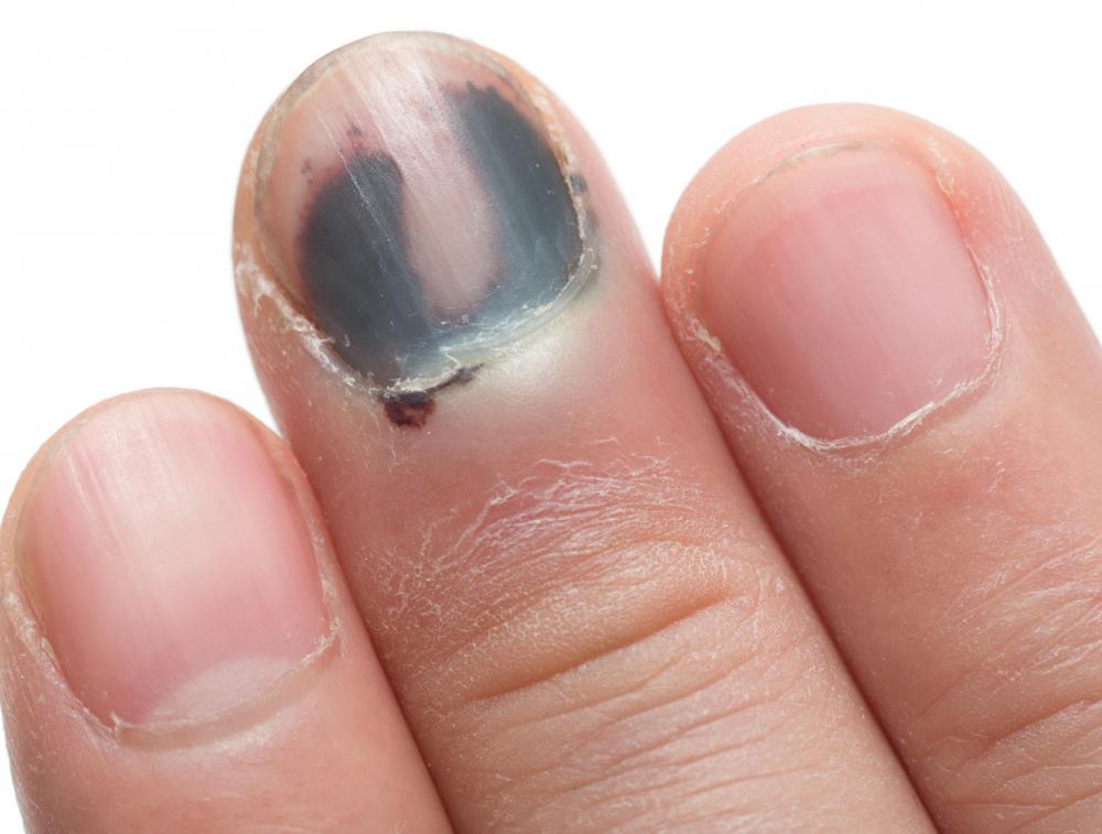 Black discoloration of finger or toe nails may be referred to as melanonychia.