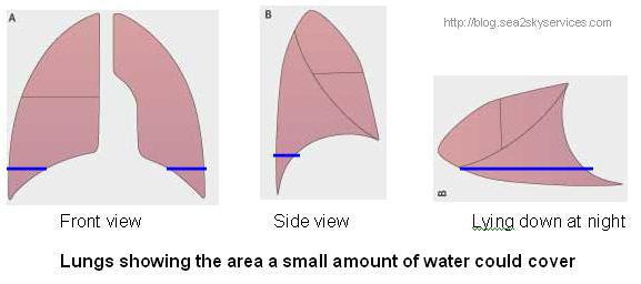 Only a small amount of fluid in the lungs can cause secondary drowning.