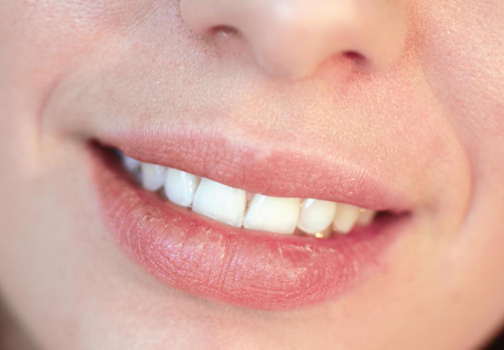 Goldenseal can help with chapped lips.