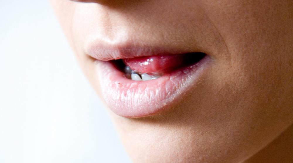 Excess saliva usually is a temporary problem.