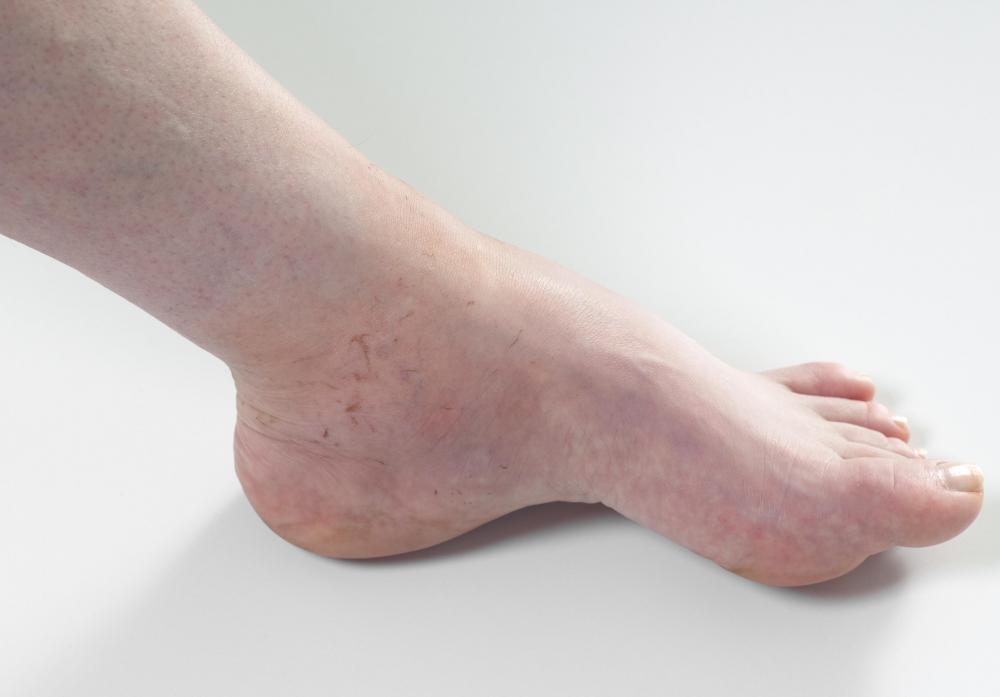 Standing for long periods of time may result in ankle edema.