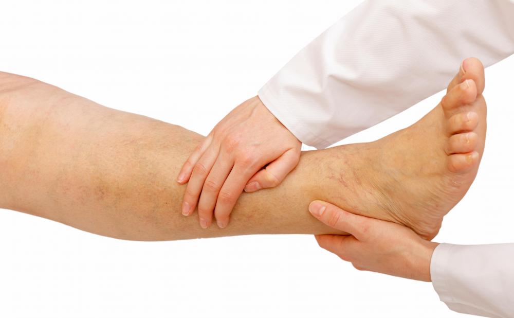 Horse chestnut can help reduce edema in the lower legs.