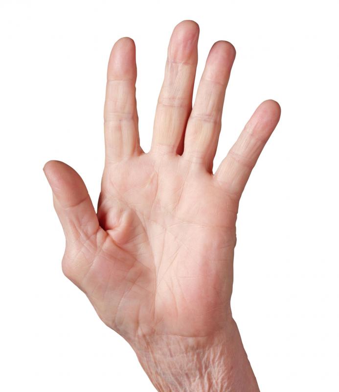A thumb with osteoarthritis.