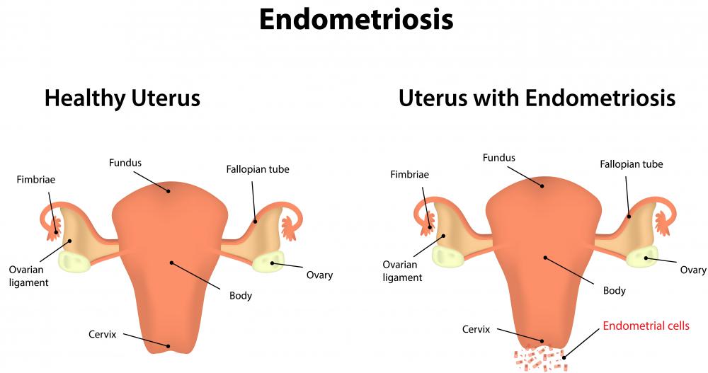 One of the most common issues involving endometrial cells is endometriosis.