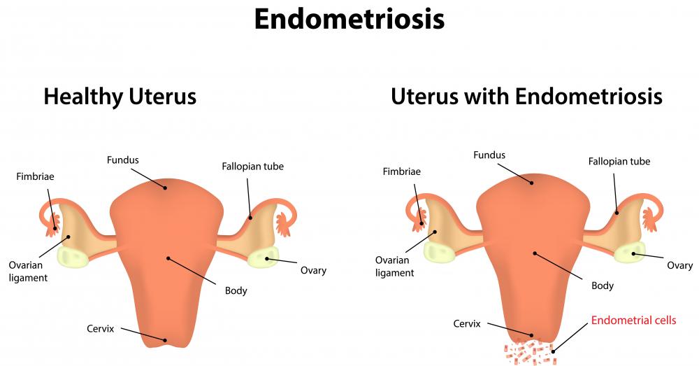 A hysterectomy may be recommended for severe endometriosis.