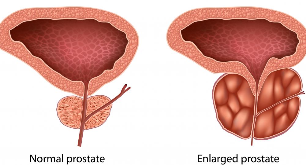 Coude catheters are designed to navigate past obstructions like a swollen prostate.
