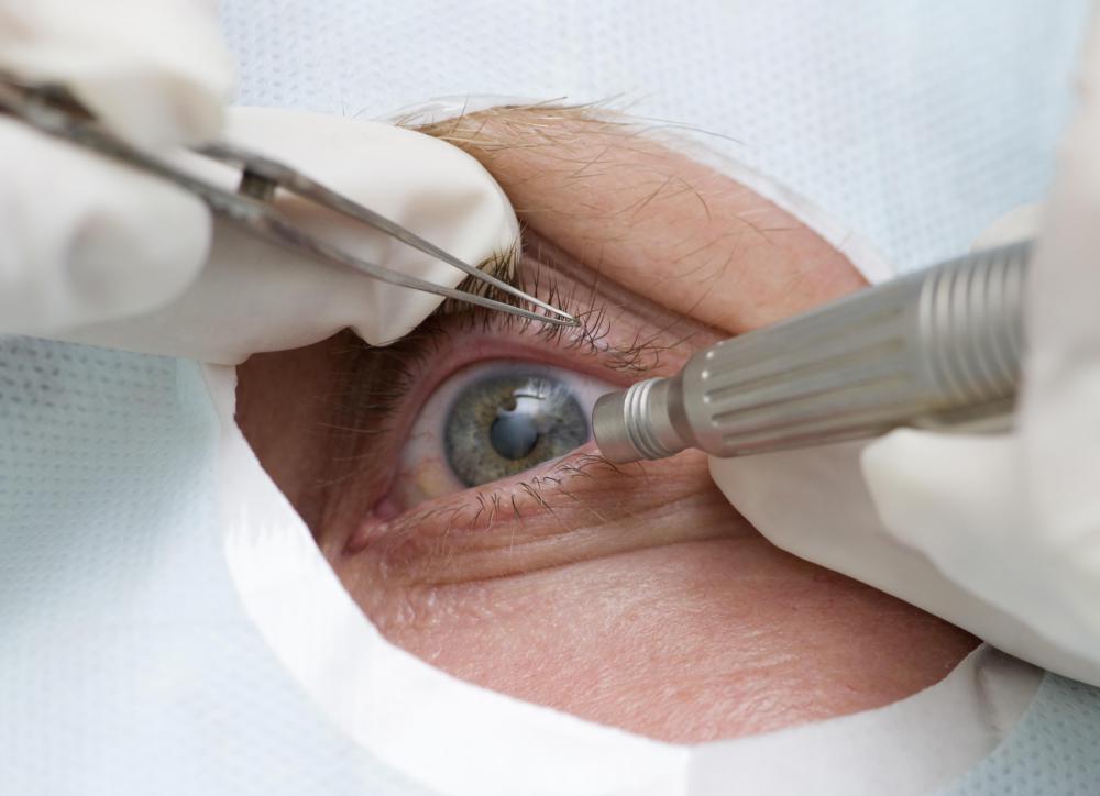 If other methods don't work, surgery to remove muscles around the eye can be an option to address eye twitching.