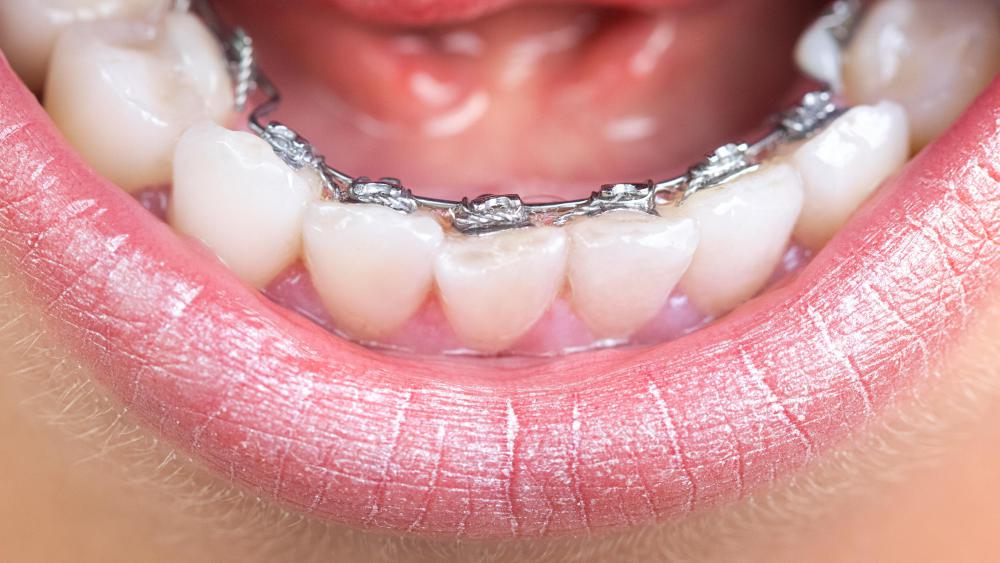 It is possible to gradually change the position of teeth through the use of orthodontic braces.