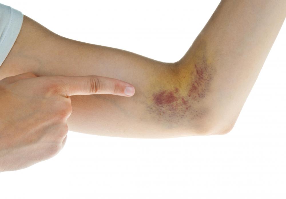 A person who takes blood thinning medications may experience bruising.