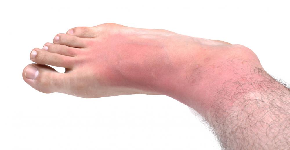 Redness is a common symptom that a blood clot is present.