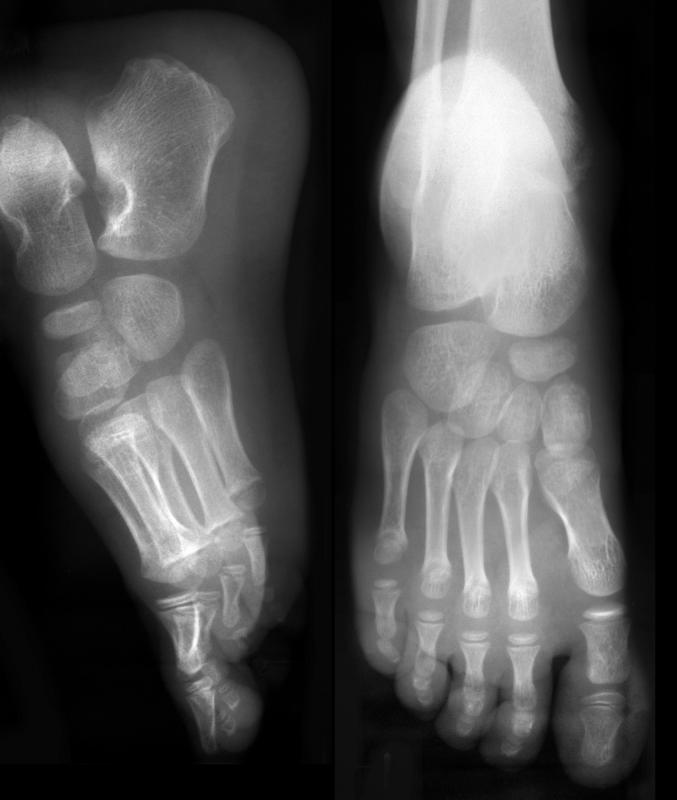 If treatments do nothing for a sore heel, an x-ray may be necessary.