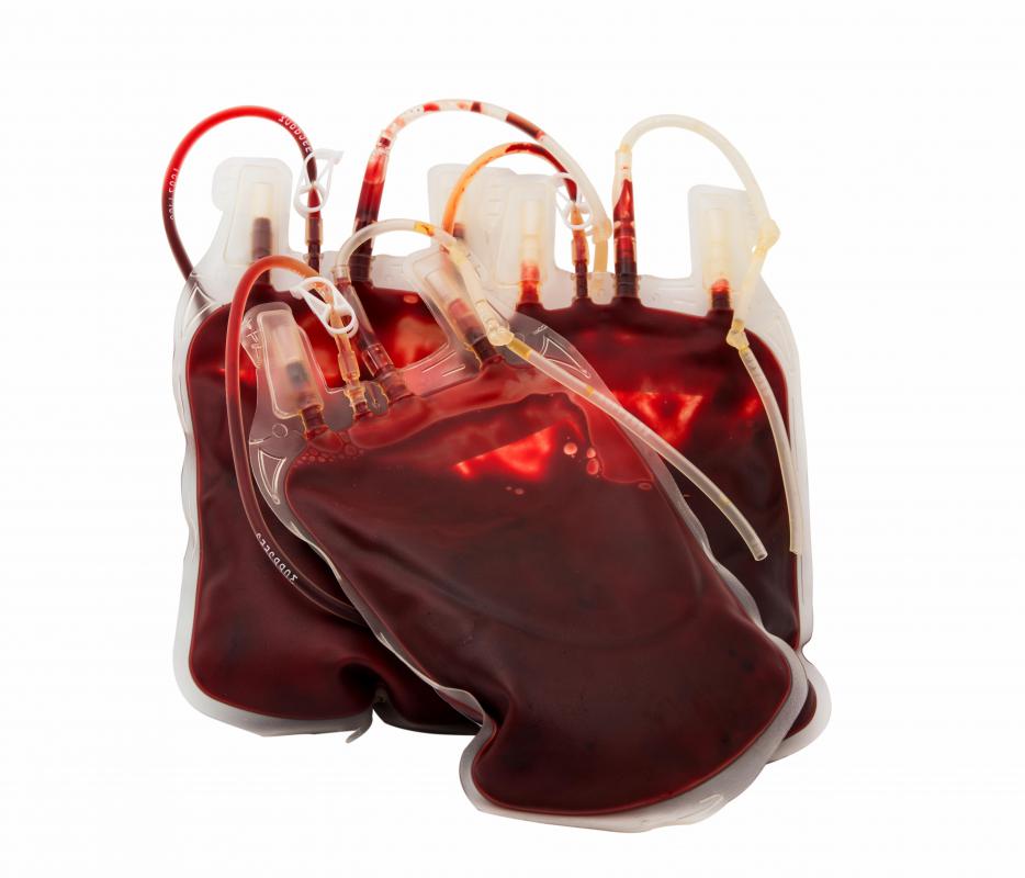 Donated blood is infused intravenously during a homologous blood transfusion.