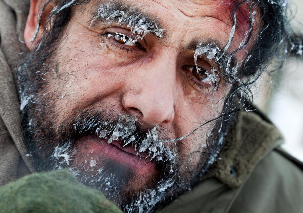 Frostbite is an example of a cold burn.