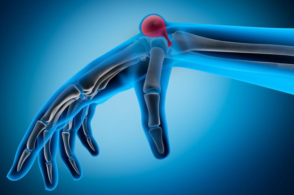 Ganglion cysts, which tend to appear on the wrists and ankles, are a common type of subcutaneous nodule.
