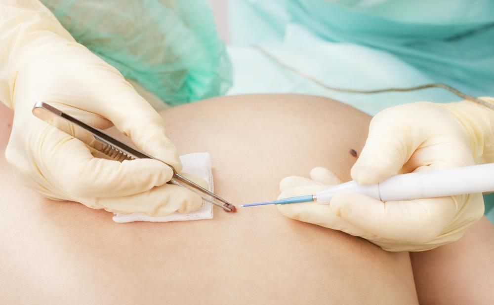 Surgical removal of the malignant skin lesion is the primary treatment for cutaneous melanoma.