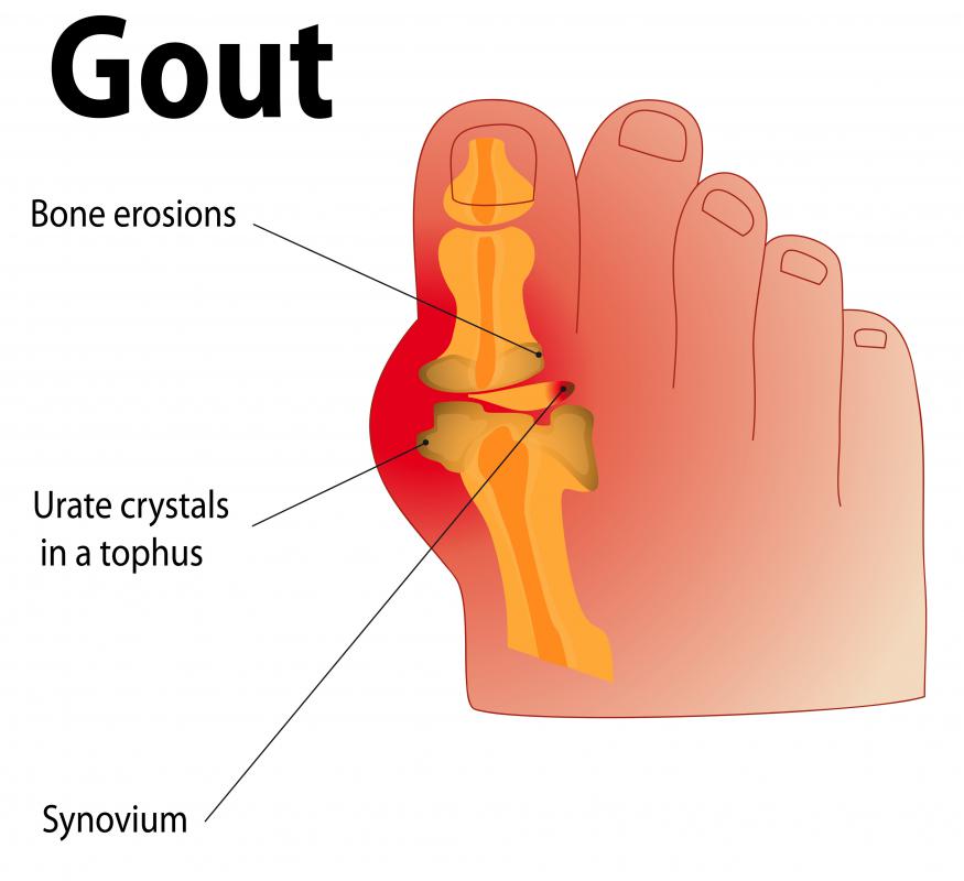 Gout may cause itchy feet at night.