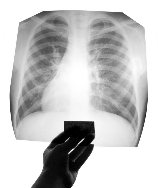 A doctor may order a chest x-ray to diagnose lung scarring.