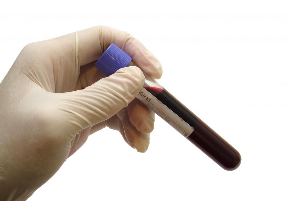 A doctor may collect a blood sample if he or she suspects the presence of infection in a patient's hand.