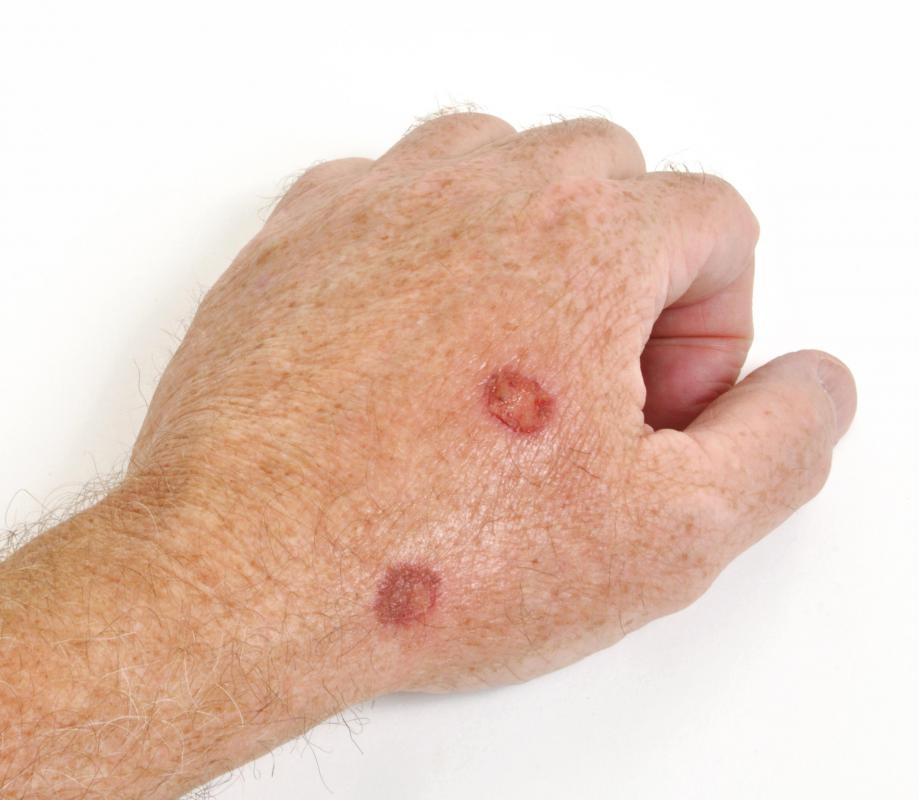 Doctors will often take a biopsy of the suspicious cell for further testing.