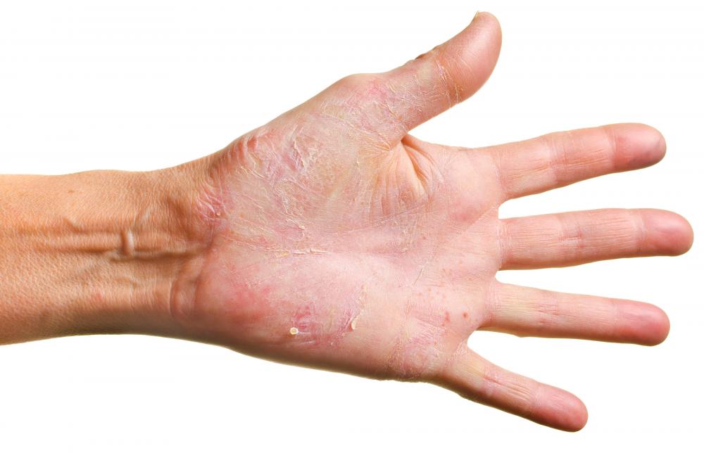 Symptoms of a spleen tumor may include itchy hands.