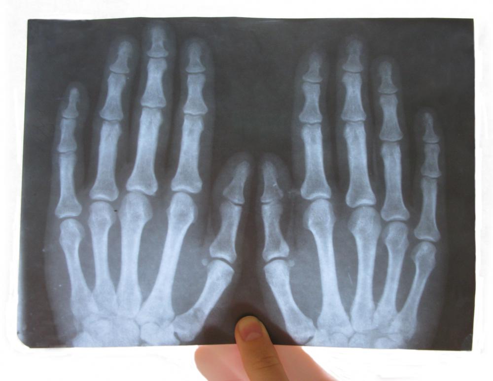 X-rays may be performed the determine the case of index finger pain.