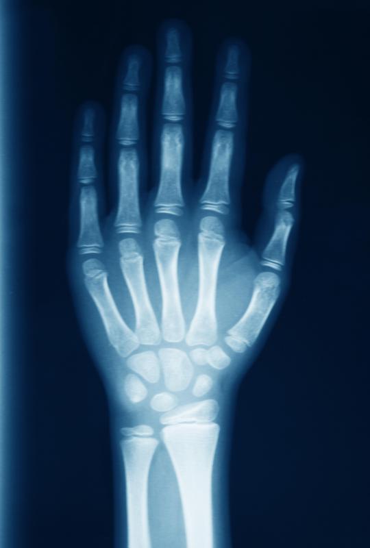 A rigid splint may be used in cases where an x-ray has confirmed a broken bone.