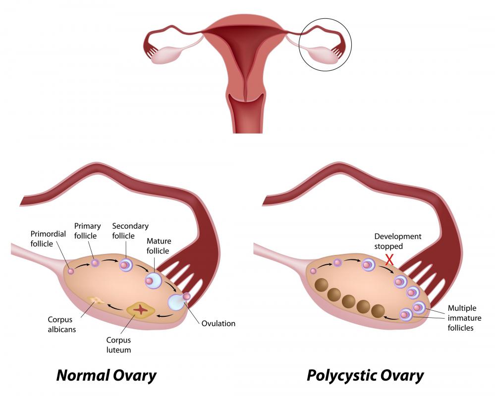 A diagram of a healthy ovary and one that is enlarged because of polycystic ovary syndrome.