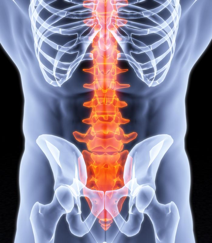 In a classic case of lumbar spondylosis, the space between the discs of the lower spine becomes narrowed.