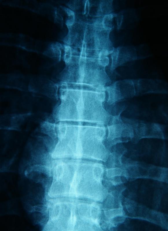 An examination of the spine and X-rays will be done to check for retrolisthesis.