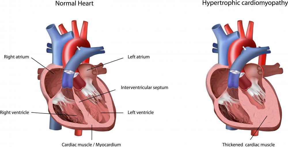 The S4 heart sound may be cause by hypertrophic cardiomyopathy.