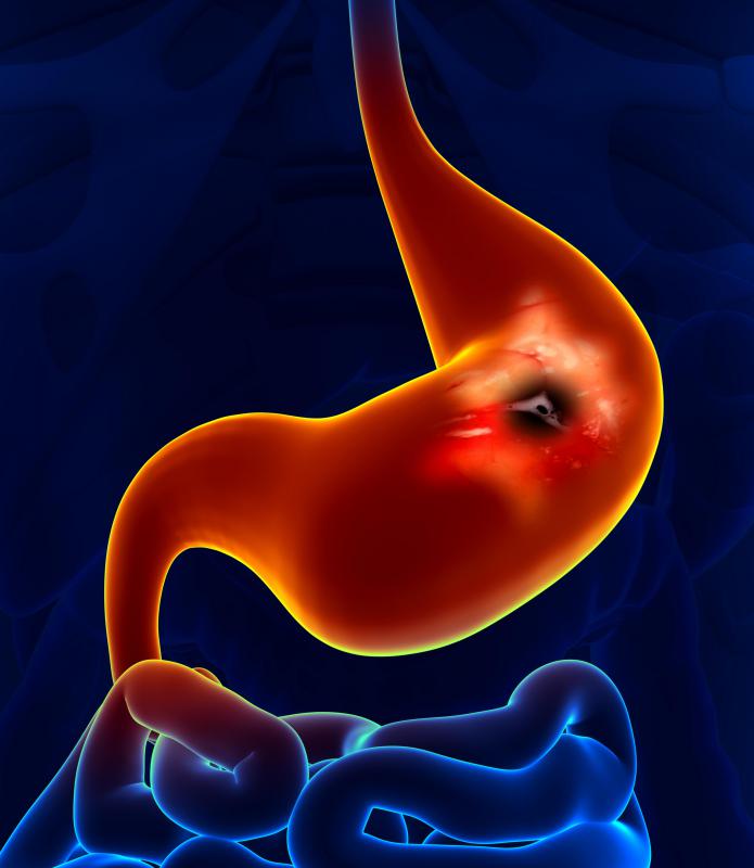 Bloody stools may occur as a result of a peptic ulcer.