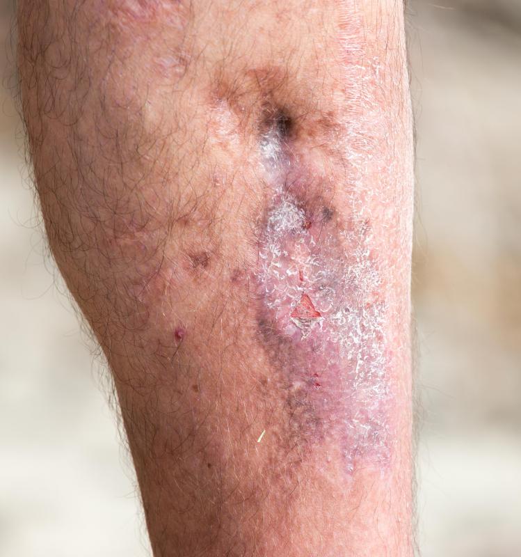 Oligomeric proanthocyanidins may improve circulation and promote healing of chronic leg ulcers and other skin conditions in the extremities.